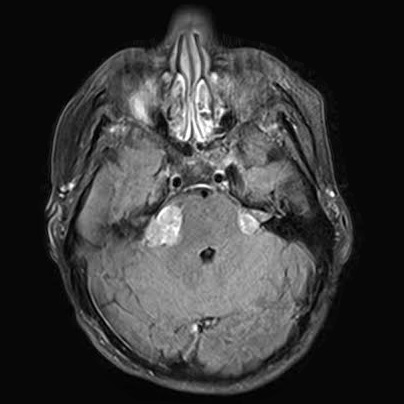 Bilateral VS, Bilateral Vestibular Schwannoma, VS, AN, Acoustic Neuroma