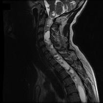 Ependymoma, Upper Spine, tumor, MRI