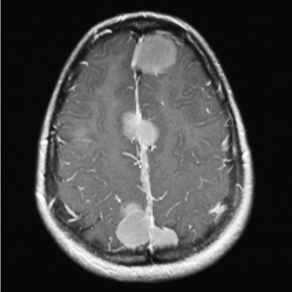 tumor, Upper Cranial Meningioma, Meningioma