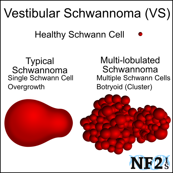 schwannoma, schwann cell, Multicentric, Multiple segmental schwannomas, tumor, Monocytic, multilobulated, multilobulated, 
					Polycystic, Multi-lobulated, neoplasm, 
					Neurofibromatosis, NF2, polyclonal, botryoid, Neurofibromatosis Type 2 Tumor, Hallmark, multilobulated VS