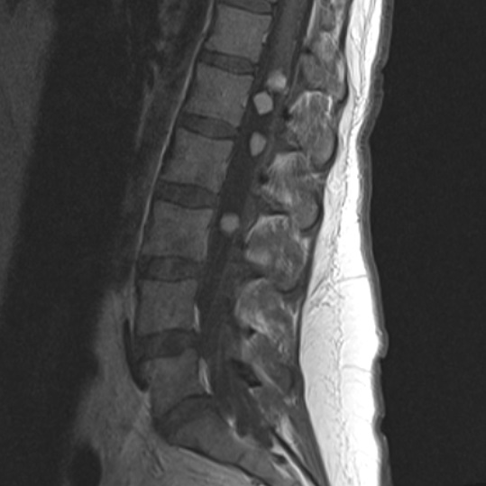 Spine Schwannoma, Spine Tumor, MRI